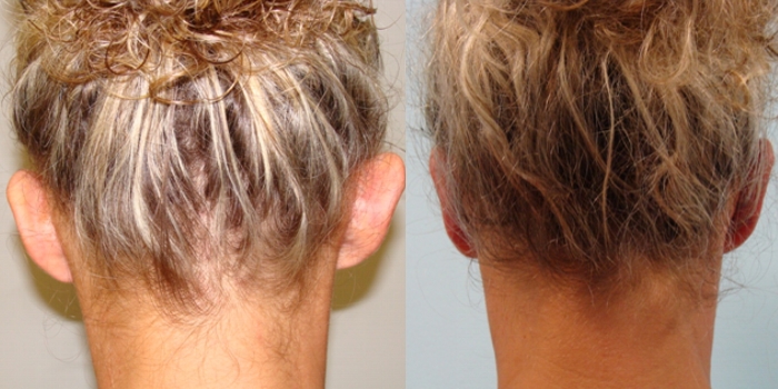 Otoplasty,  after 7 days